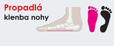 Prepadnutá klenba nohy – príznaky, liečba a tipy na vhodnú obuv | ARNO-obuv.sk - obuv s tradíciou